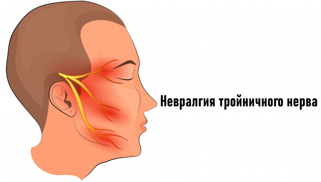 Симптомы воспаления тройничного нерва
