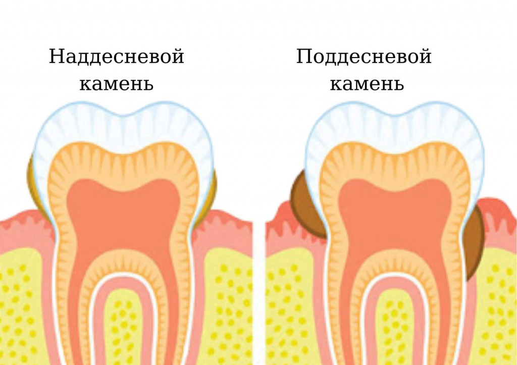 Зубной камень – нарушение эстетичности зубного ряда
