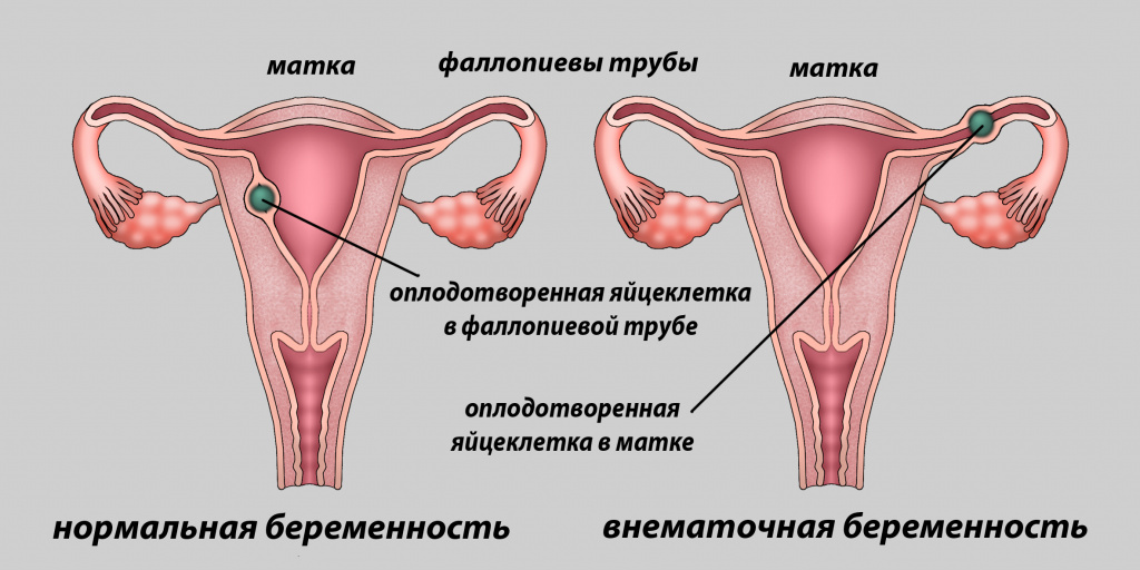 Mimoděložní těhotenství: jak rozpoznat příznaky v raných stádiích