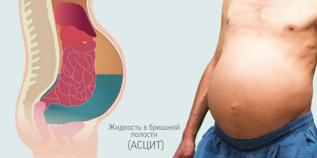 Асцит: методы диагностирования и лечение