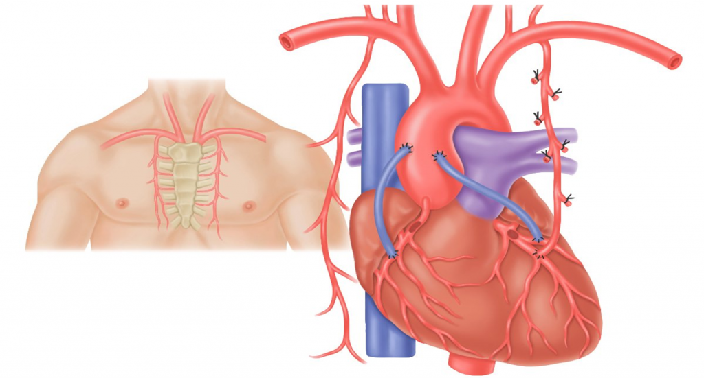 Особенности аортокоронарного шунтирования сердца