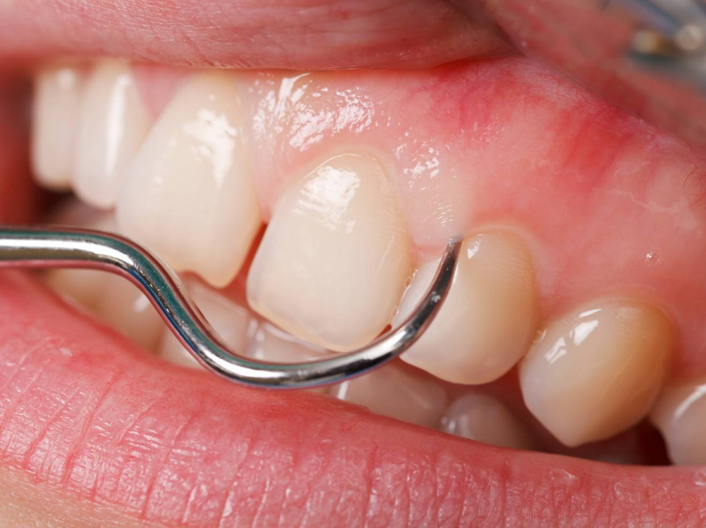 Воспаленная десна около зуба: как вылечить