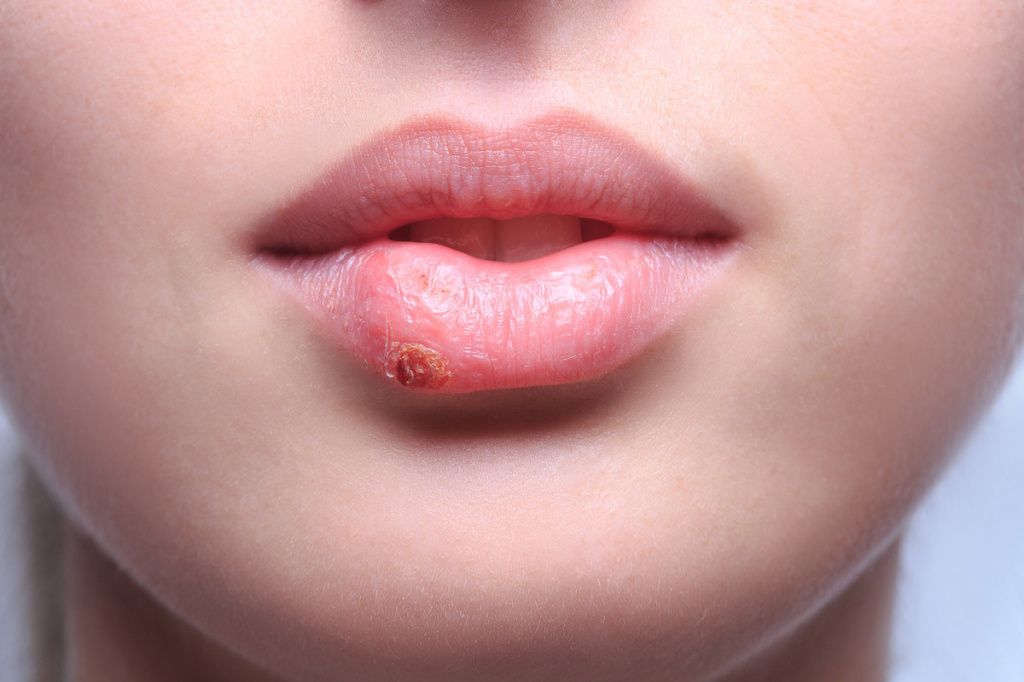 Герпес на губах: причины появления, симптомы, к какому врачу обращаться