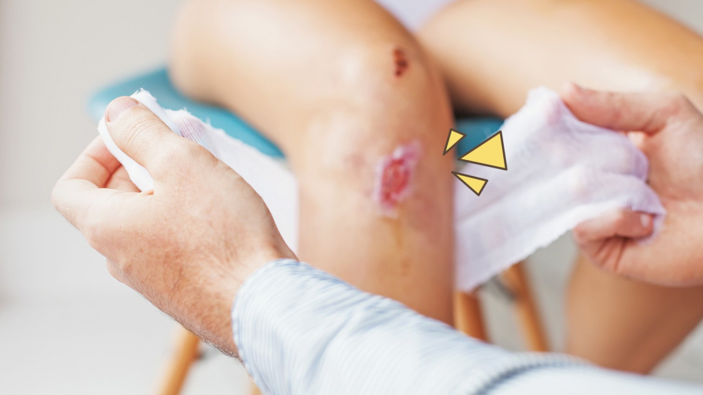 Гнойные раны: признаки и лечение