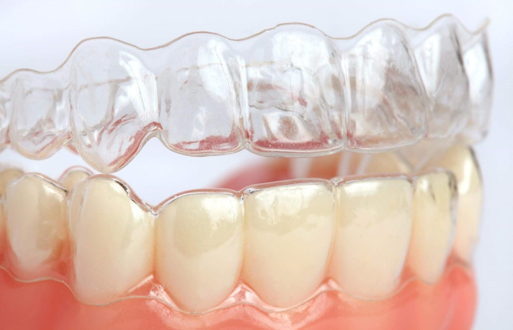 Элайнер – качественное выравнивание зубного ряда