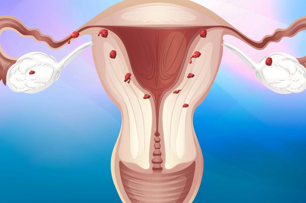 Признаки аденомиоза матки на узи что
