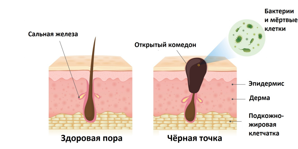 Komedony: terapie, odrůdy